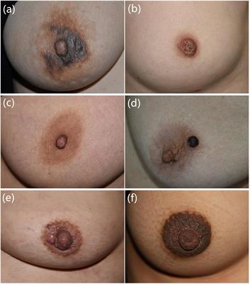 Skin diseases of the nipple and areola complex: A case series study from China